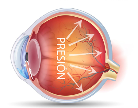 GLAUCOMA-TREATMENT